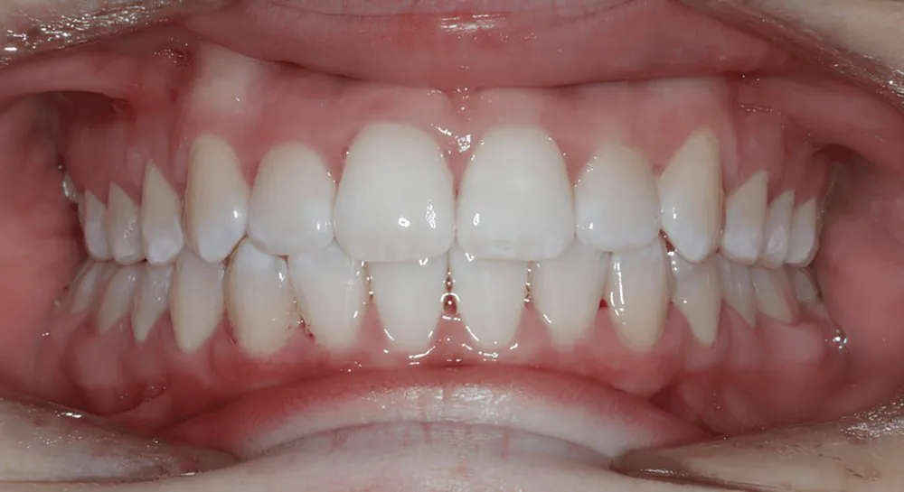 Orthodontics, case 1, teeth view: before and after, after
