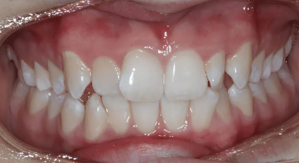 Orthodontics, case 1, teeth view: before and after, before
