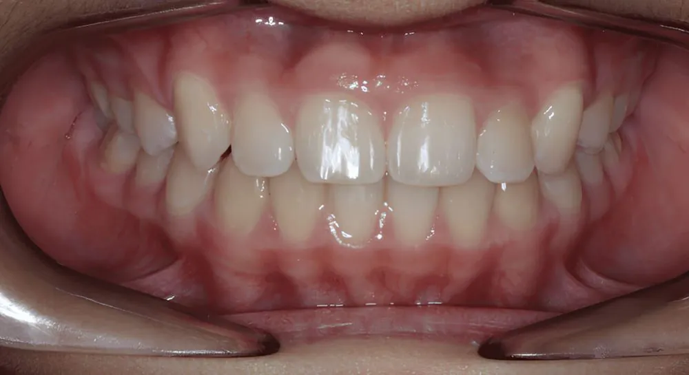 Orthodontics, case 11, teeth view: before and after, after