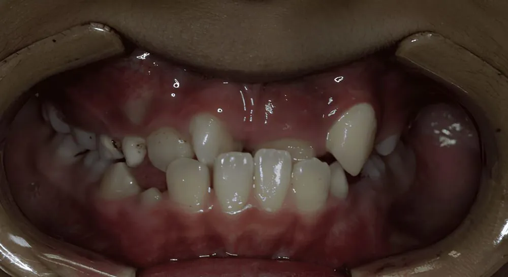 Orthodontics, case 11, teeth view: before and after, before