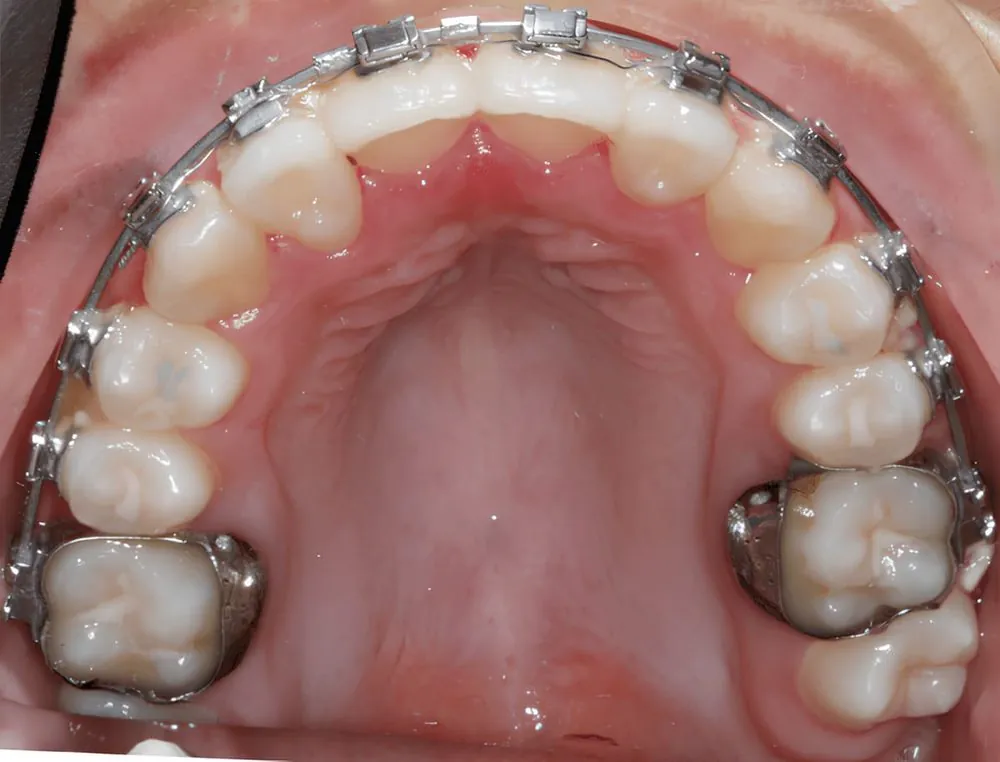 Upper arch expansion, case 12, teeth view: before and after, after