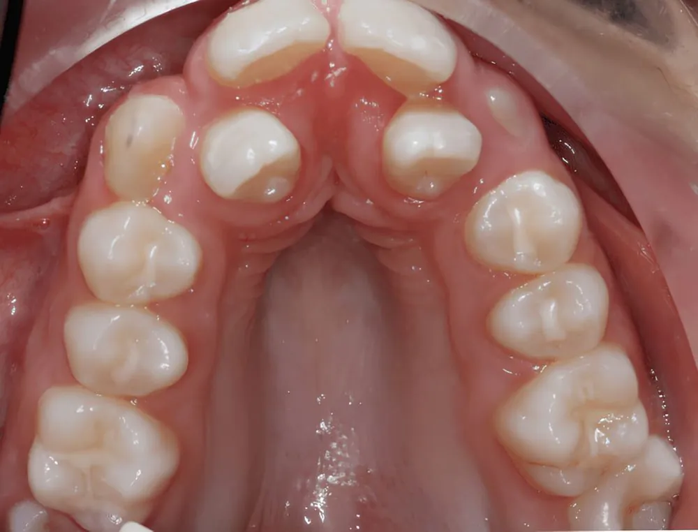Upper arch expansion, case 12, teeth view: before and after, before