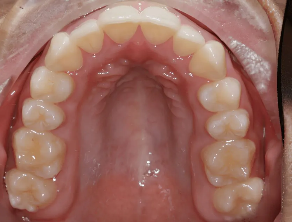 Upper arch expansion, case 13, teeth view: before and after, after