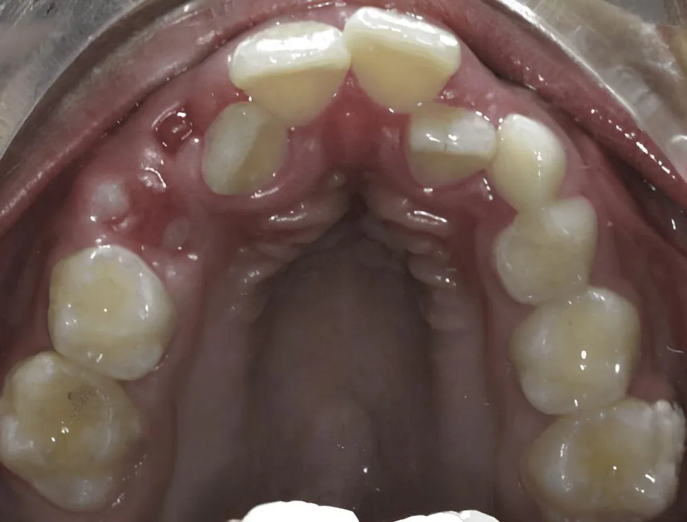 Upper arch expansion, case 13, teeth view: before and after, before
