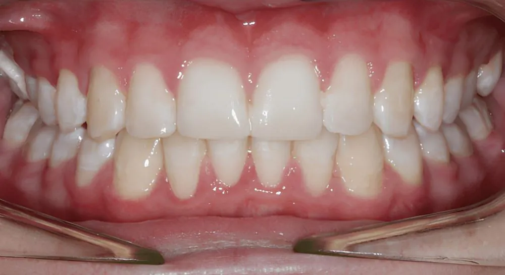 Orthodontics, case 3, teeth view: before and after, after