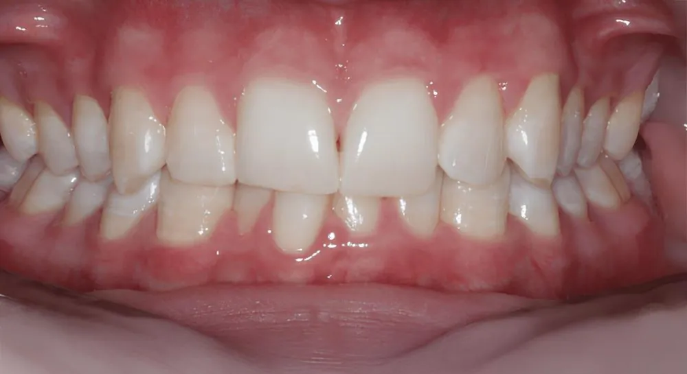 Orthodontics, case 3, teeth view: before and after, before