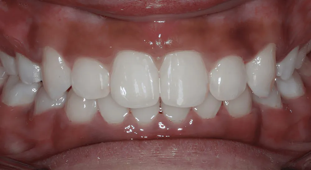 Orthodontics, case 4, teeth view: before and after, after