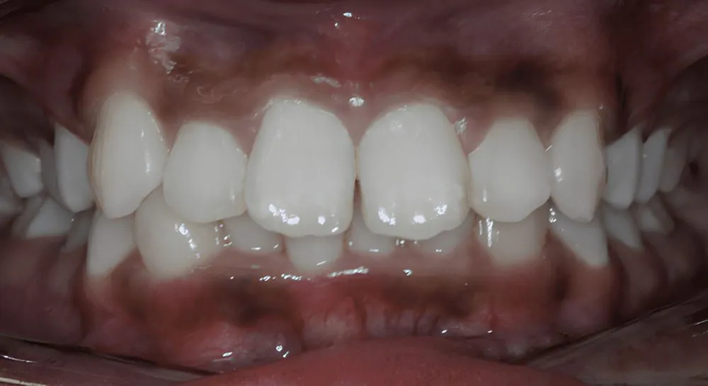 Orthodontics, case 4, teeth view: before and after, before
