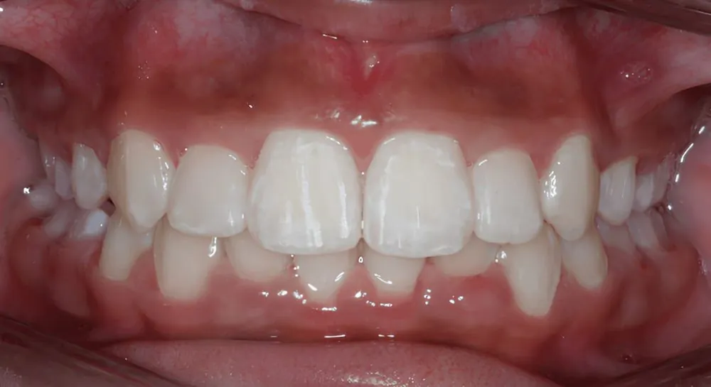Orthodontics, case 5, teeth view: before and after, after