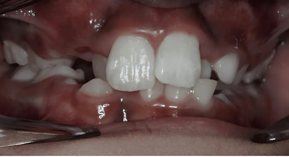 Orthodontics, case 5, teeth view: before and after, before