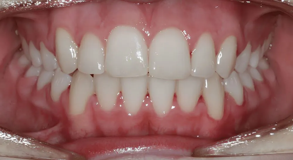 Orthodontics, case 6, teeth view: before and after, after