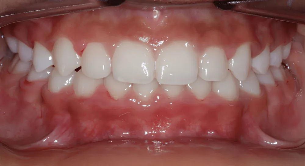 Orthodontics, case 6, teeth view: before and after, before