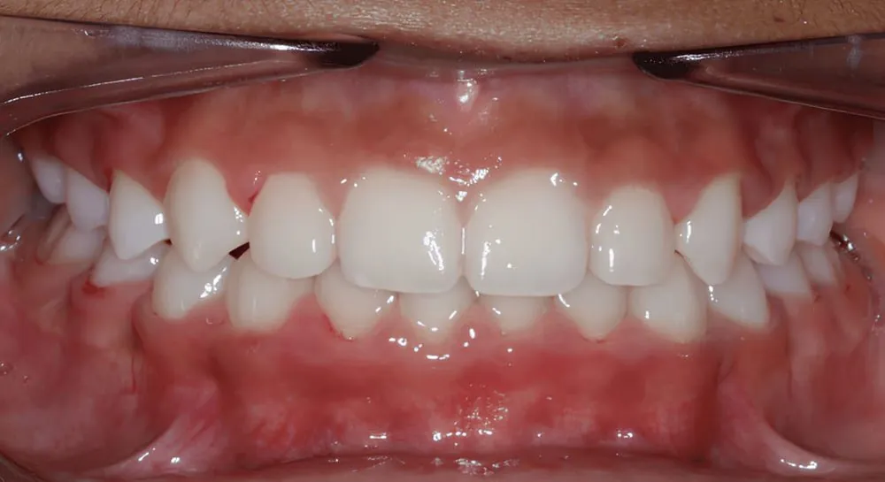 Orthodontics, case 7, teeth view: before and after, after