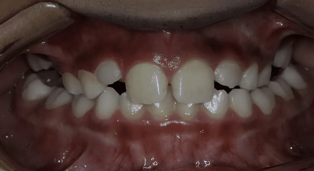 Orthodontics, case 7, teeth view: before and after, before