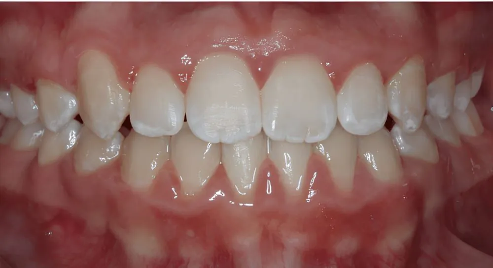 Orthodontics, case 8, teeth view: before and after, after