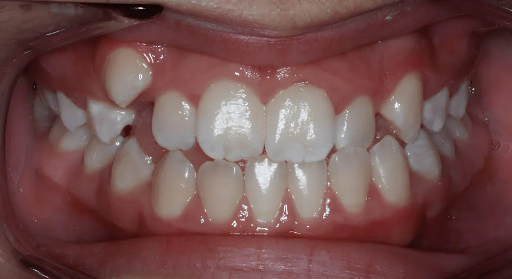 Orthodontics, case 8, teeth view: before and after, before