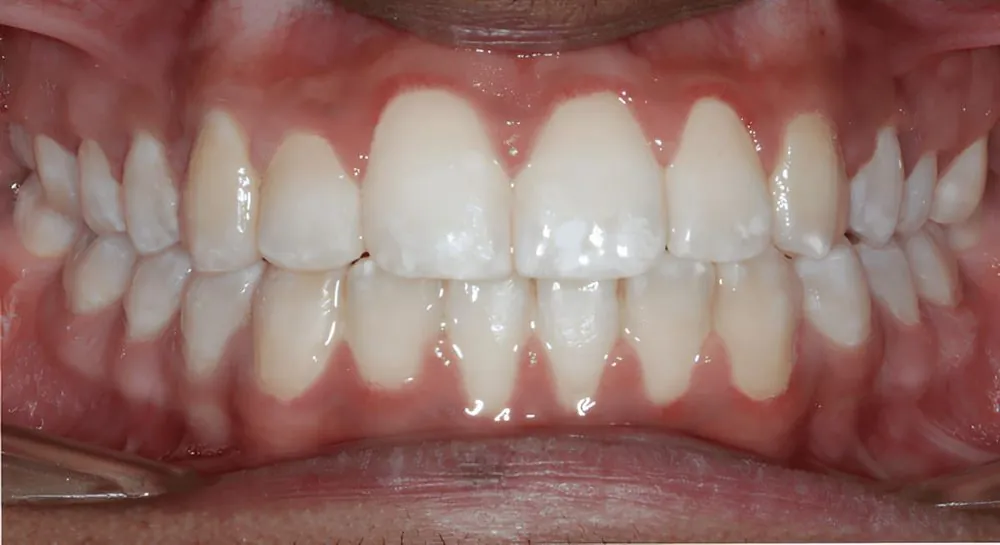 Orthodontics, case 9, teeth view: before and after, after