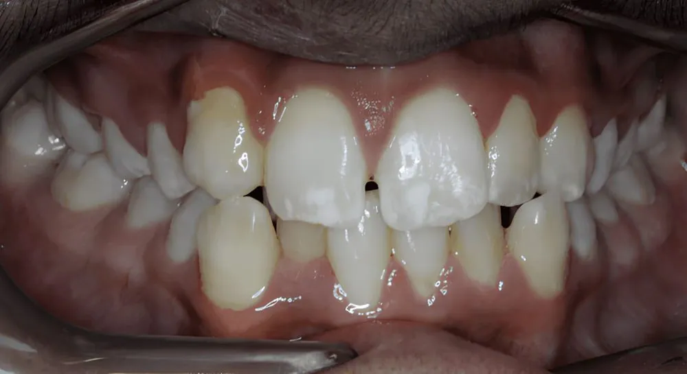 Orthodontics, case 9, teeth view: before and after, before