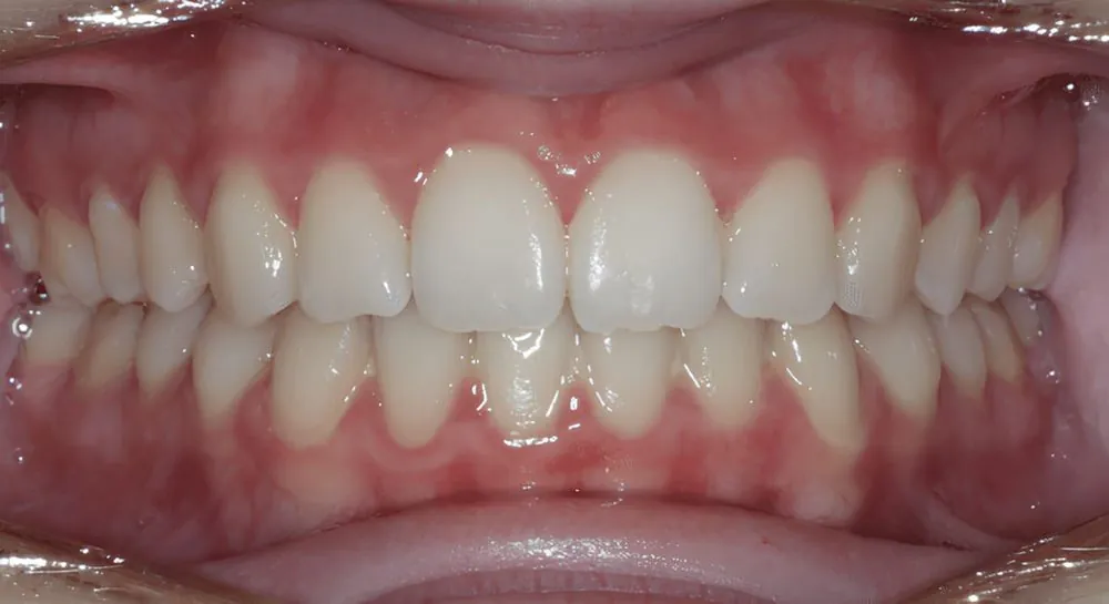 Orthodontics, case 10, teeth view: before and after, after