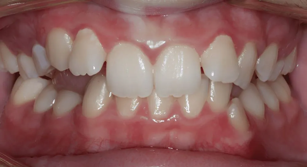 Orthodontics, case 10, teeth view: before and after, before