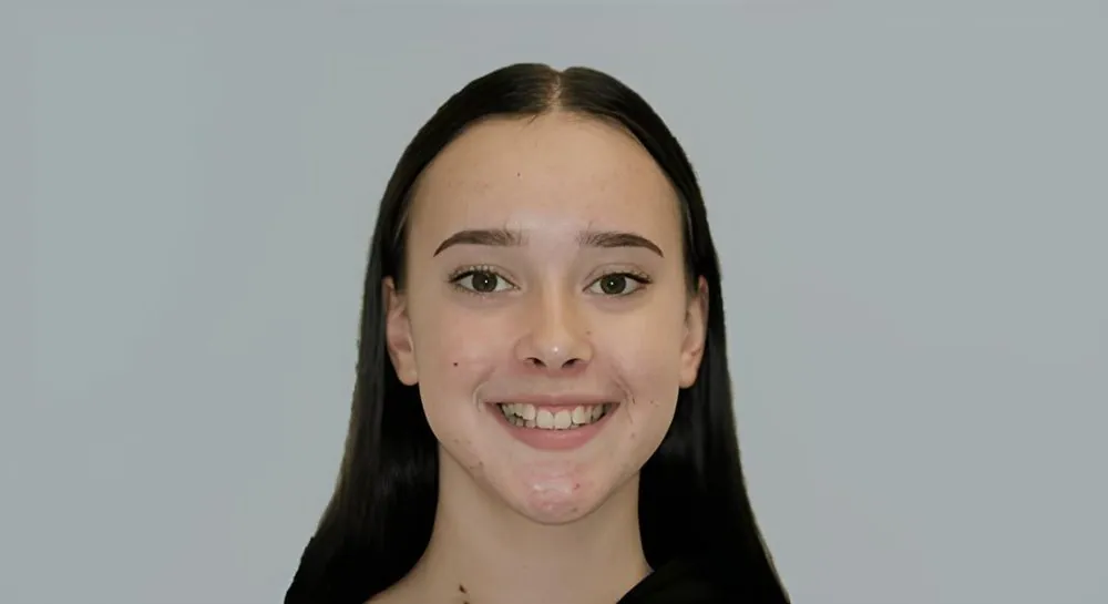 Orthodontics, case 10, smile view: before and after, before