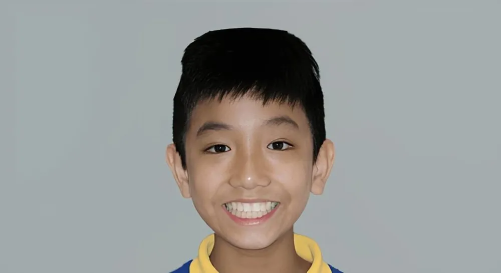 Orthodontics, case 11, smile view: before and after, after