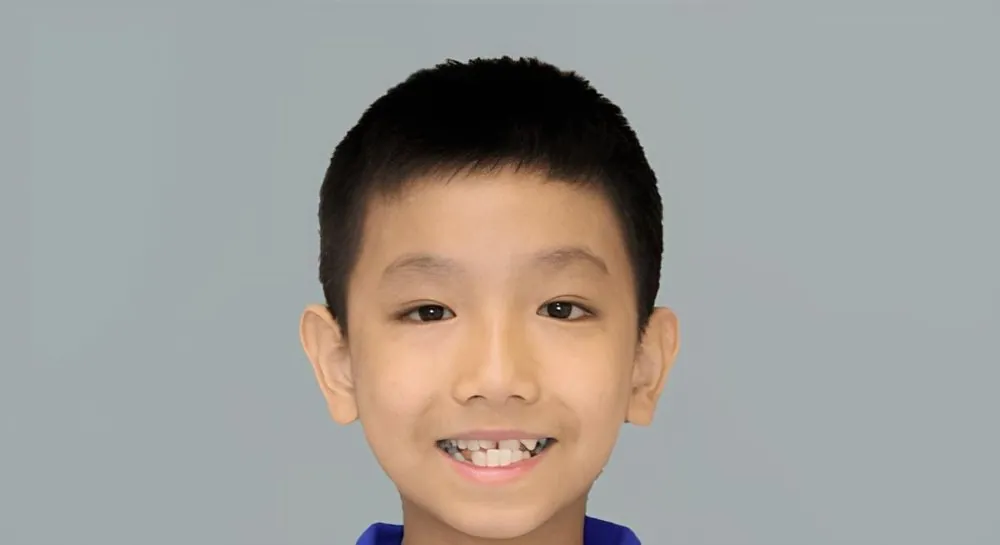 Orthodontics, case 11, smile view: before and after, before