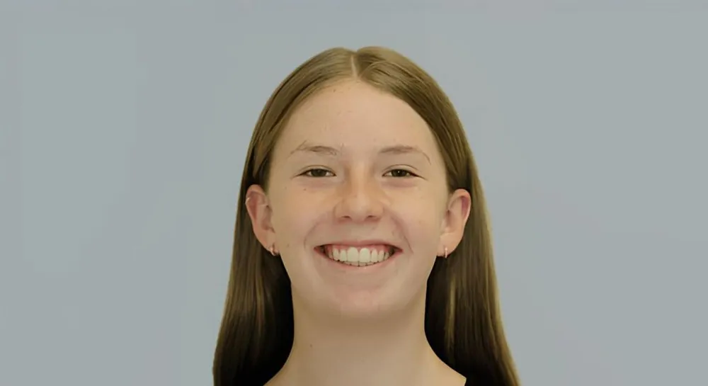 Orthodontics, case 6: before and after, after