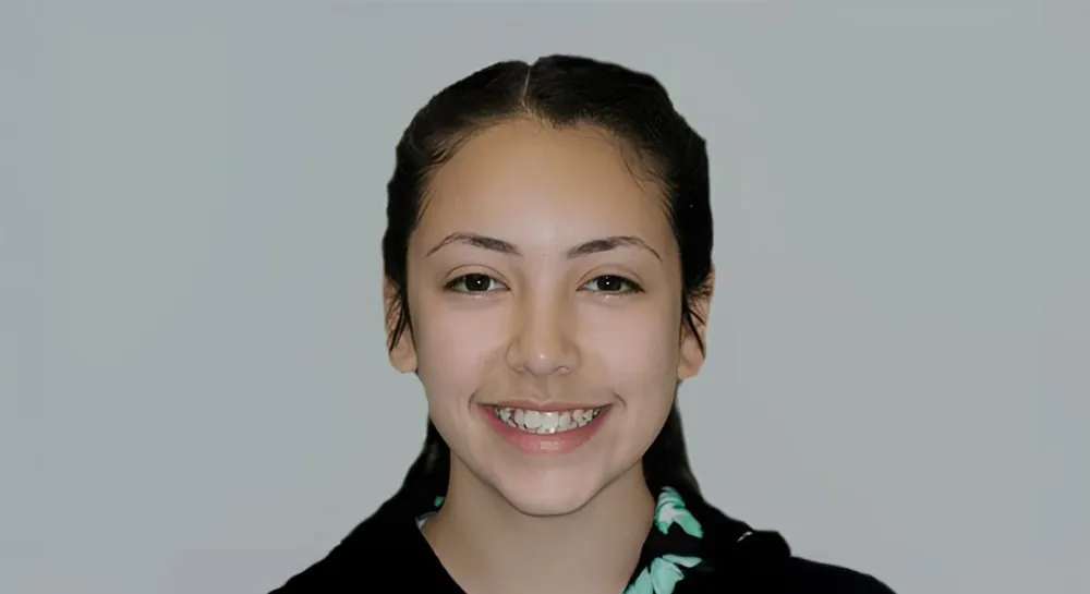 Orthodontic alignment, case 8: before and after, before